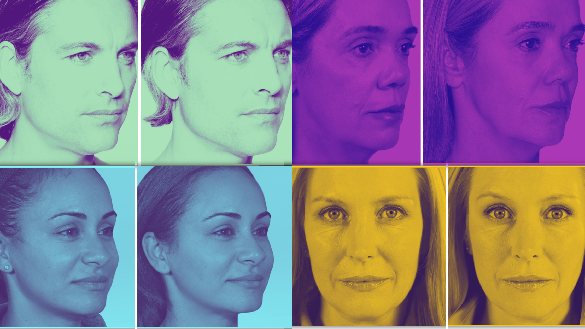 Sculptra before and after results showing mechanism comparison and visual transformation