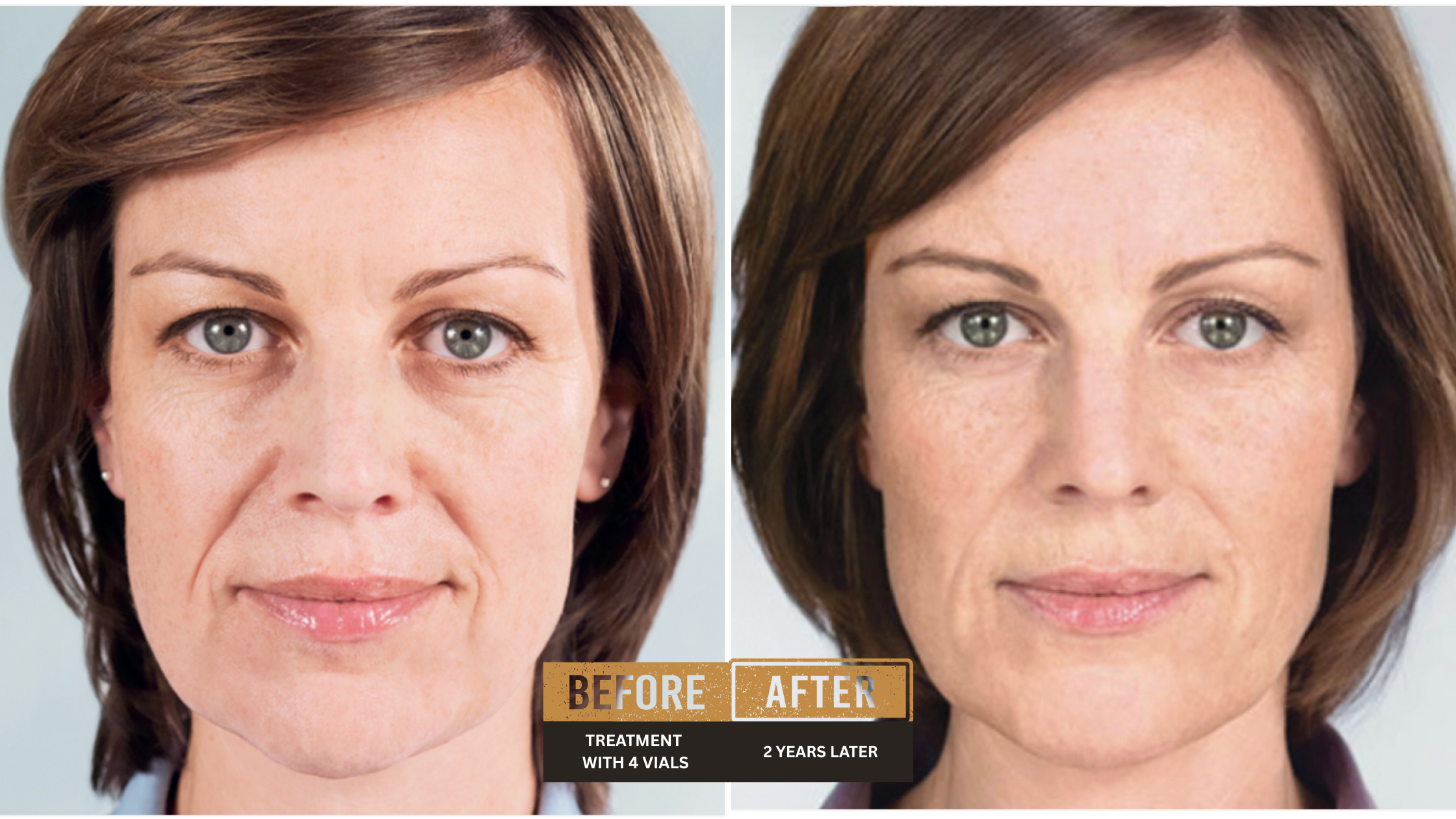 Sculptra before and after results - 2 years later with 4 vials showing natural volume restoration